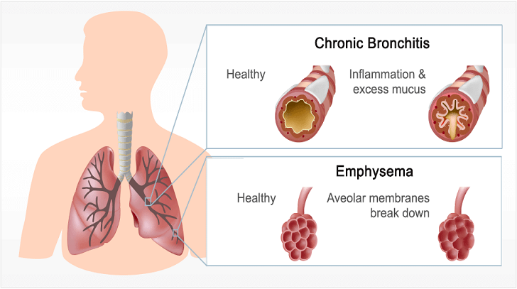 Chronic Bronchitis